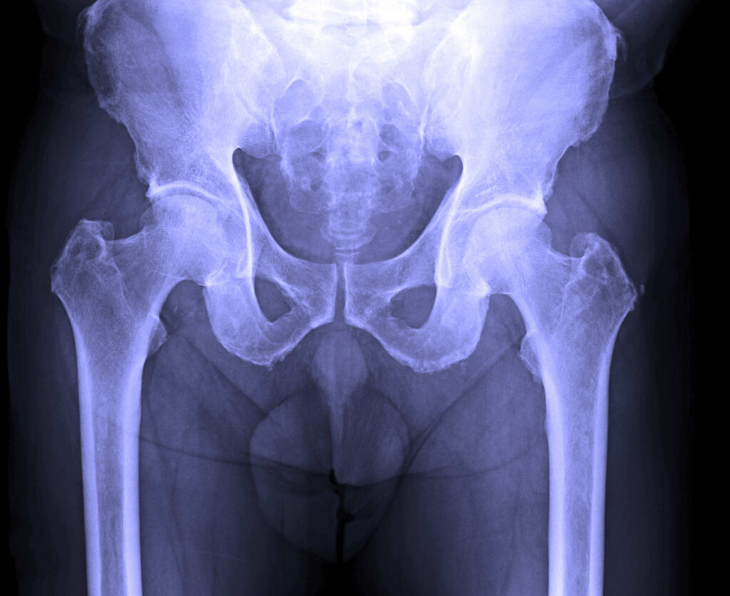 Hip scan from a New Port Richey accident victim