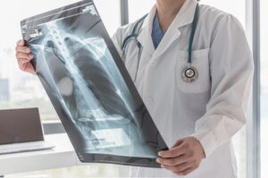 How Our Tampa Car Accident Lawyers Can Help You Pursue Compensation for Chest Injuries