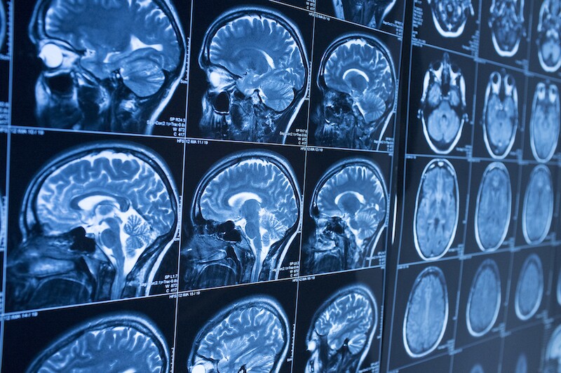 What Is CTE?