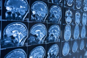 Understanding the Potential Severity of Brain Injuries