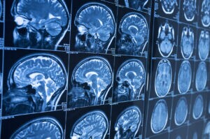 How Roman Austin Car Accident and Personal Injury Lawyers﻿﻿ Helps Brain Injury Victims in Palm Harbor, FL